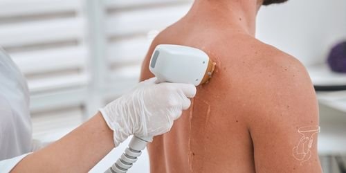 My Lazer Shot - Epilation Laser Hommes