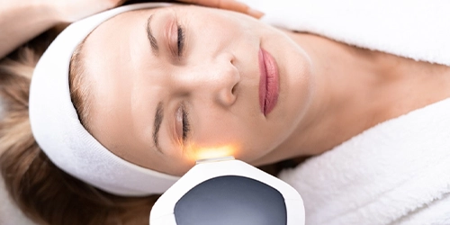 Photorajeunissement IPL – My Lazer Shot